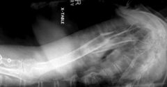 <p>Evaluation Criteria: Horizontal Beam Transthoracic Lateral Humerus (Trauma)</p>