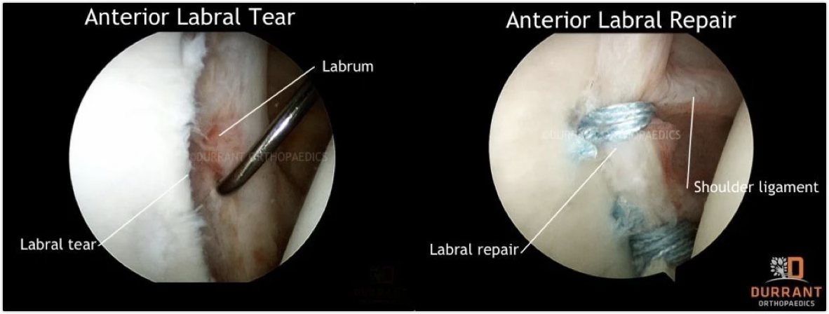 <p>GH labral tear treatment </p>
