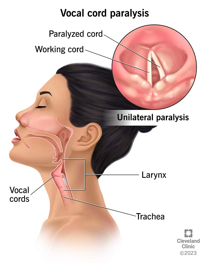 <p>hoarseness</p>
