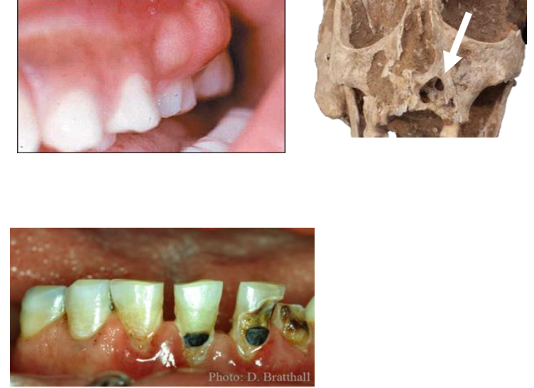 <p>Inflammatory or Infectious Disease Example: Dental abcesses &amp; caries</p>