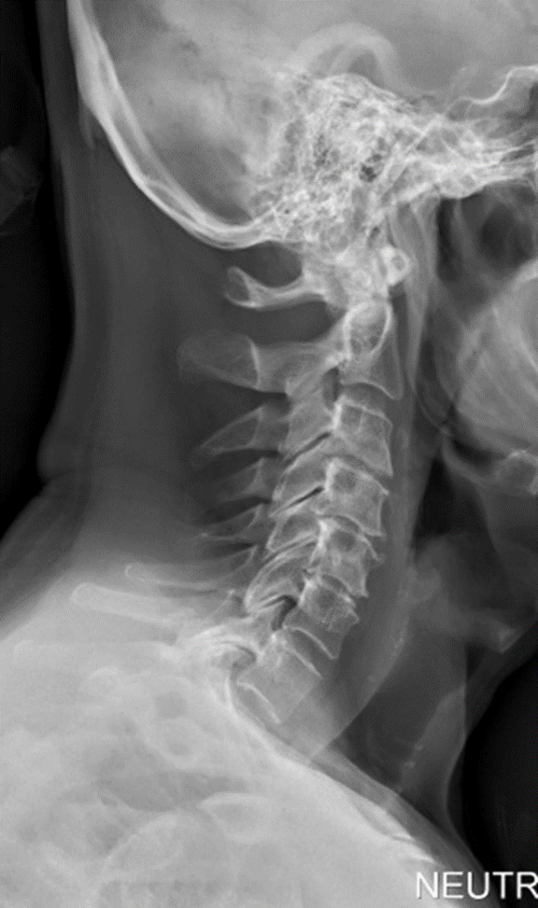 <p>herniated nucleus pulposus (HNP) radiographic appearance </p>