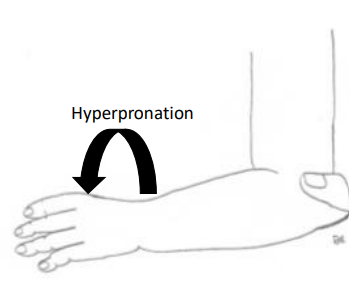 <p>Hyperpronation</p>