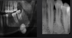 <p>How is this lesion described in terms of density?</p>