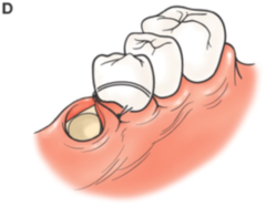 <p>For primary closure of buccal and lingual flaps; holds flaps more coronally than apically.</p><p>(Explanation: This suture is ideal for aligning flaps tightly at the coronal level, ensuring close adaptation for healing, especially in flap surgeries where primary closure (edge-to-edge contact) is achievable.)</p>