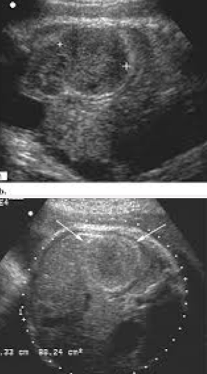 <ul><li><p>most fetal liver tumors appear as solid masses, sometimes with cystic components; may be calcified</p></li><li><p>liver calcification may be observed as isolated echogenic focus</p><ul><li><p>is usually a benign finding</p></li><li><p>if multiple calcifications seen within liver, other organs such as brain and spleen may be affected</p></li></ul></li></ul><p></p>