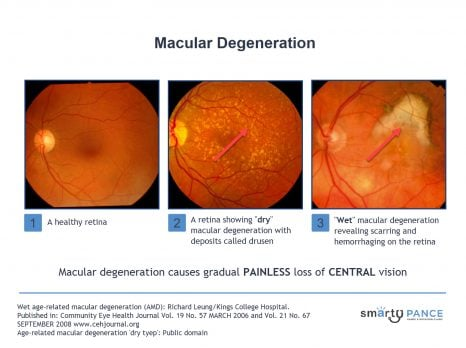 <p>What type of macular degeneration is being described?</p><p>-Most common</p><p>-Atrophic changes with age, which is a slow gradual breakdown of the macula</p><p>-Drusen → yellow retinal deposits </p>