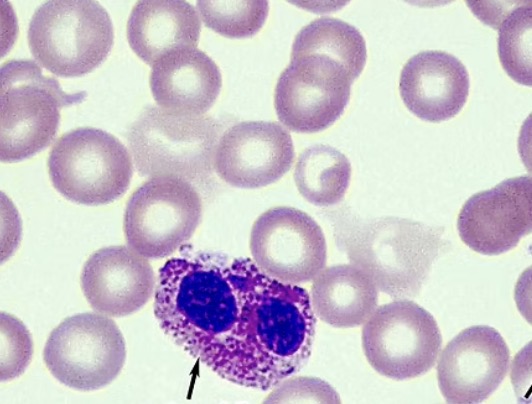 <p><span>less common leukocyte that has a purple nucleus with orange/red cytoplasm</span></p><p class="s13"><span>○Named for the acidic stain eosin</span></p><p class="s13"><span>○Granules are orange to red</span></p><p class="s13"><span>○Nucleus is lobed with 2-3 lobes</span></p><p class="s13"><span>○High eosinophil count is seen with parasitic worms</span></p>