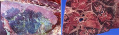 <p>This respiratory bacteria of cattle causes fibrinosuppurative hemorrhagic bronchopneumonia, extensive thrombosis, necrotic foci (much larger than BRSV), and red to black areas of cranioventral consolidation</p>
