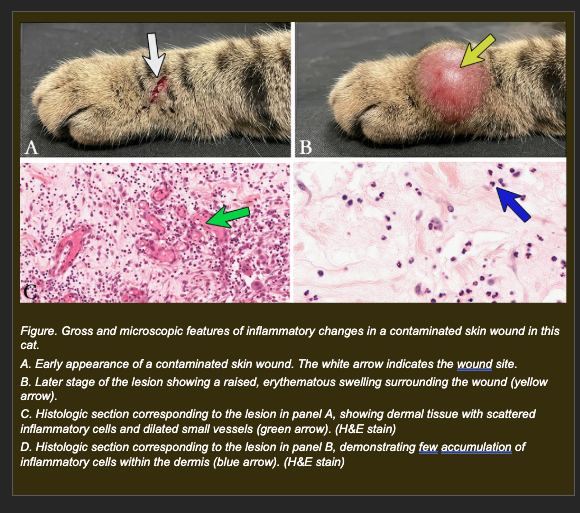 <p>A cat develops a contaminated skin wound. Redness and swelling develop appropriately within the first few hours, indicating that the vascular events of acute inflammation are proceeding normally. Despite this, the bacterial infection worsens over the following 48 hours.</p><p>Histologic examination shows:</p><p>- Dilated dermal vessels with marginating leukocytes visible at vessel walls</p><p>- Very few leukocytes within the dermis or wound tissue -- leukocytes are present in blood but not migrating into tissue</p><p>- Bacteria visible within the wound tissue</p><p>- No significant phagocytic activity in the wound</p><p></p><p><strong>Which interpretation best explains why the bacterial infection is worsening despite normal vascular events?</strong></p><p>a. The vascular events have created appropriate conditions for leukocyte delivery, but leukocytes are failing to migrate from blood vessels into the infected tissue -- preventing phagocytosis and bacterial clearance</p><p>b. Increased vascular permeability is diluting the antibacterial proteins in the wound, allowing bacteria to survive in the protein-rich exudate</p><p>c. The bacteria have developed resistance to the mediators released during the vascular phase, preventing inflammatory recognition</p><p>d. Lymphatic obstruction is preventing clearance of bacteria from the wound site, allowing them to accumulate</p>