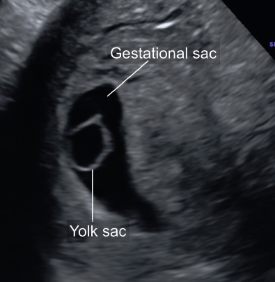 <p>7. What is the likely outcome of Figure 23-30?</p><p>a. Normal pregnancy</p><p>b. Ectopic pregnancy</p><p>c. Anembryonic gestation</p><p>d. Abortion</p>