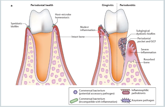 <ul><li><p>in periodontal health - symbiotic bacterial community and helps regulate host immune repsonse - homeostatsis </p></li><li><p>gingivitis - increase in number of immflamic pathobionts and commensal bacteria → accesory pathogens. there are also keystone pathogens becuase although they are low in abundance they can orchestrate a biofilm formation and can manipulate the host resposneto their favour in order to aquire nutrients - enabling their survival but also causes tissue damage </p></li><li><p>which may lead to periodontal tissue destruction </p></li></ul><p></p>
