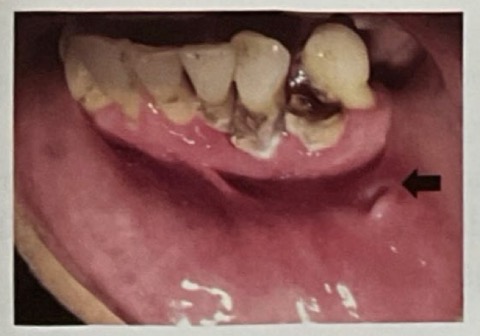 <p>BN CÓ VẾT LOÉT NHƯ HÌNH </p><p>CHẨN ĐOÁN</p>