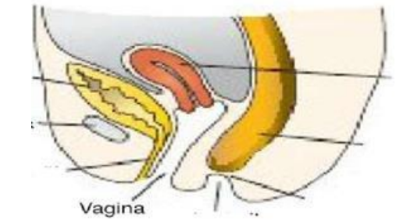 <p>Hình ảnh sau nguyên nhân có thể là do:</p><p>A. Màng hậu môn không thủng</p><p>B. Không có lõm hậu môn</p><p>C. Bất sản ống hậu môn</p><p>D. Dò trực tràng âm đạo</p>