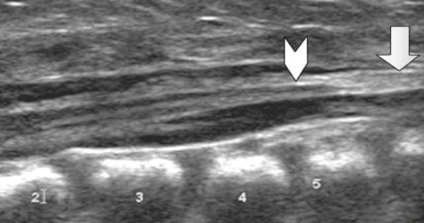 <p>malformation when spinal cord is attached to the surrounding tissue </p>