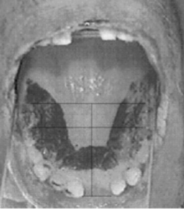 <p>broad contact well behind upper teeth</p>