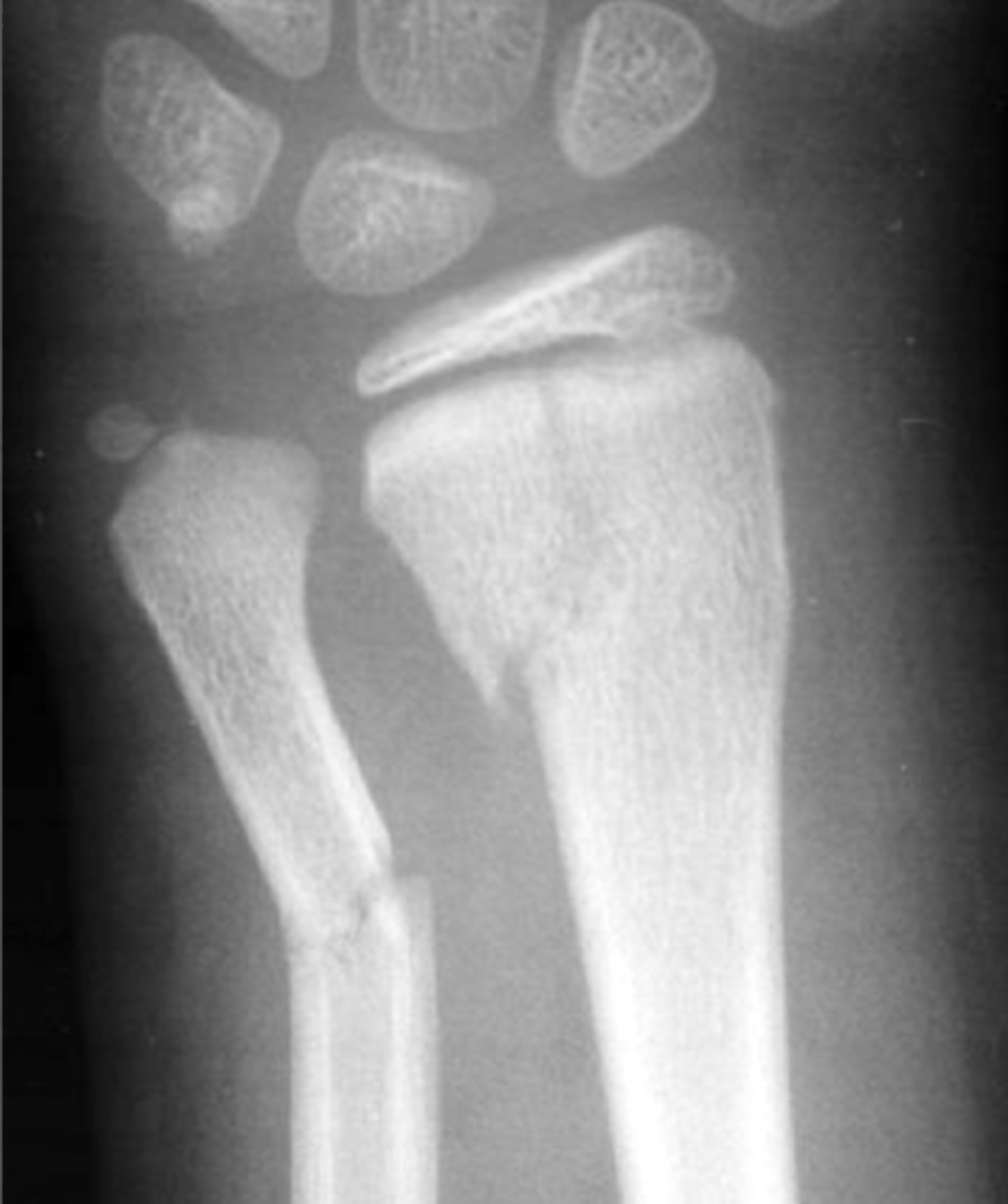 <p>physeal plate fracture with metaphyseal fracture</p>
