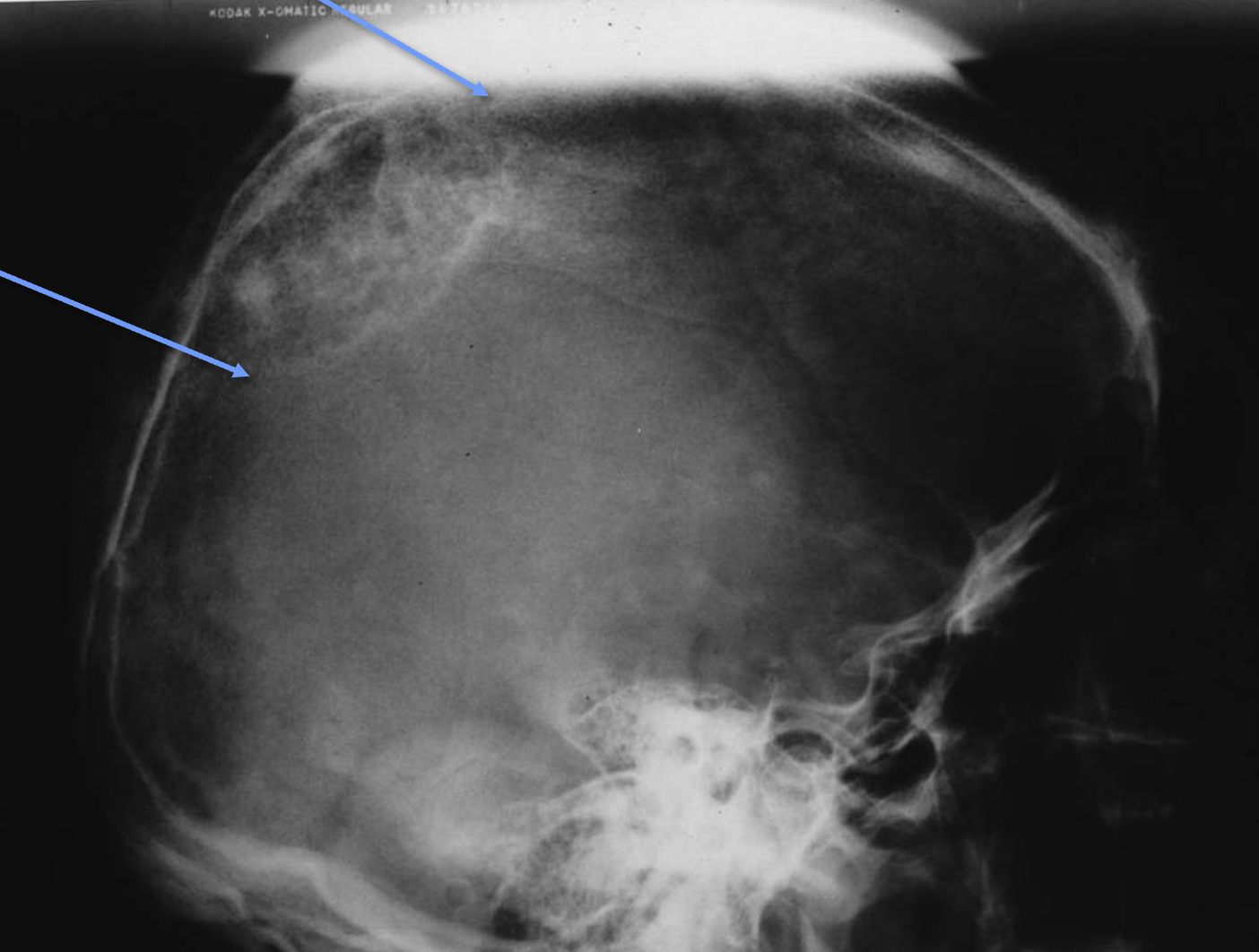 <p>What tumour like disorder is this, what can you see?</p>