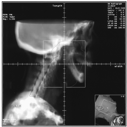 <ul><li><p><span>An 2D image reconstructed from CT data to create a beam’s-eye-view (BEV) display of the treatment field</span></p></li><li><p><span>These images resemble conventional radiographs</span></p></li></ul><p></p>