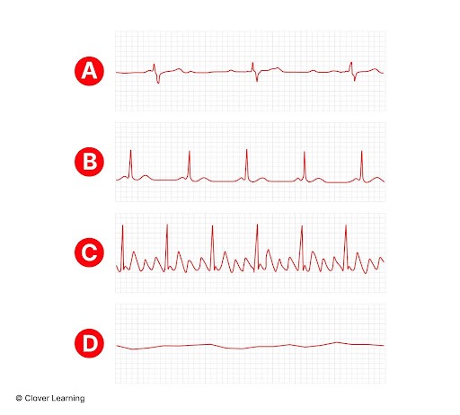 <p>The EKG rhythm indicated by the letter D is:</p>