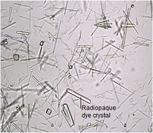 <p>Abnormal (acidic urine).</p><p>Specific gravity >1.040</p><p>Long, thin pointed rectangles or flat four-sided notched plates. Similar to cholesterol, but not accompanied by proteinuria or lipiduria</p>