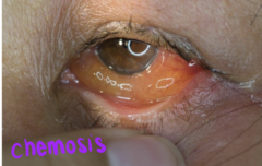 <p>- itchy eyes</p><p>- bilateral redness, mild burning sensation</p><p>- conjunctiva edema (chemosis - iris is normal)</p><p>- epiphora (watery eyes), NONPURULENT</p><p>- cobblestone papillae</p>