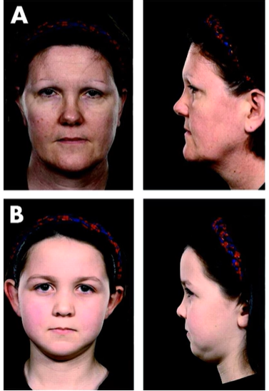 <ul><li><p>Autosomal dominant</p></li><li><p>Collagenopathy </p><ul><li><p>Type 2 and Type 11</p></li></ul></li><li><p>Characteristic faces</p><ul><li><p>Flat faces/changes to ocular bones/present w/ hearing loss or joint problems/under developed bones in the middle of the face-cheek + nose </p></li><li><p>Implications when prescribing lenses/ bridge design</p></li></ul></li><li><p>Ophthalmology</p><ul><li><p>Myopia</p></li><li><p>Paediatric cataract</p></li><li><p>Lattice - radial</p></li><li><p>RD</p></li><li><p>Glaucoma</p></li></ul></li></ul><p></p>