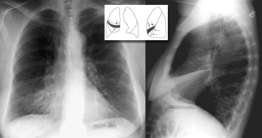 <p>Frontal view: Subtle. Silhouetting of right heart border by collapsed medial segment of middle lobe may be only clue. <br>Lateral view: Triangular opacity anteriorly. </p>