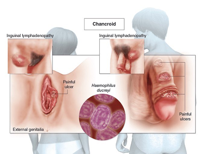<p>STI leading to genital ulcers, lymphadenopathy, and bubo formation</p><p>-10% coinfection with HSV or syphilis </p><p>-Presentation: 1 or more painful genital ulcers that are well-defined with irregular orders, followed by painful inguinal lymphadenopathy that can liquify and become fluctuant </p><p>-Dx: clinical, PCR to rule out HSV, RPR/VRDL to rule out syphilis </p><p>-Tx: Ceftriaxone or azithromycin</p>
