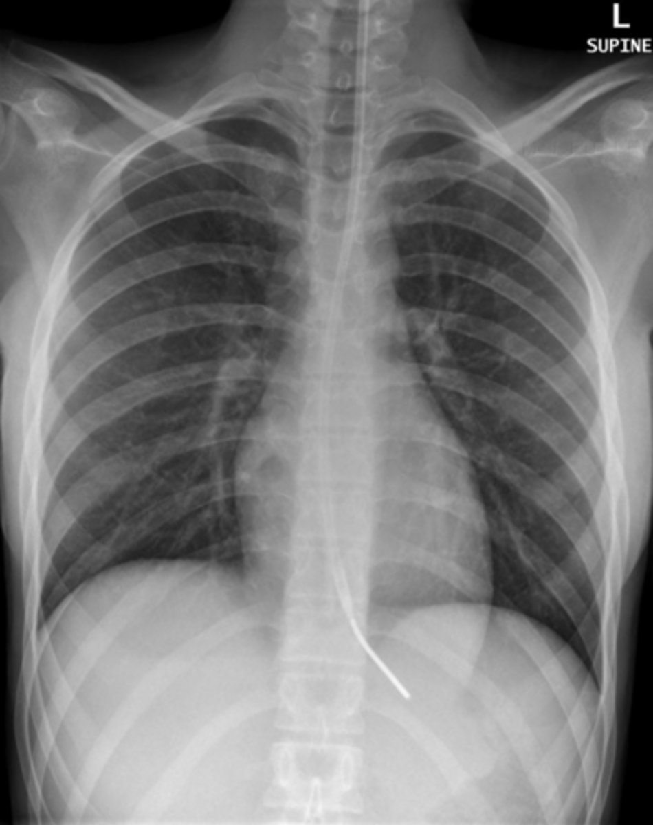 <p>the tube is not fully in the stomach</p>
