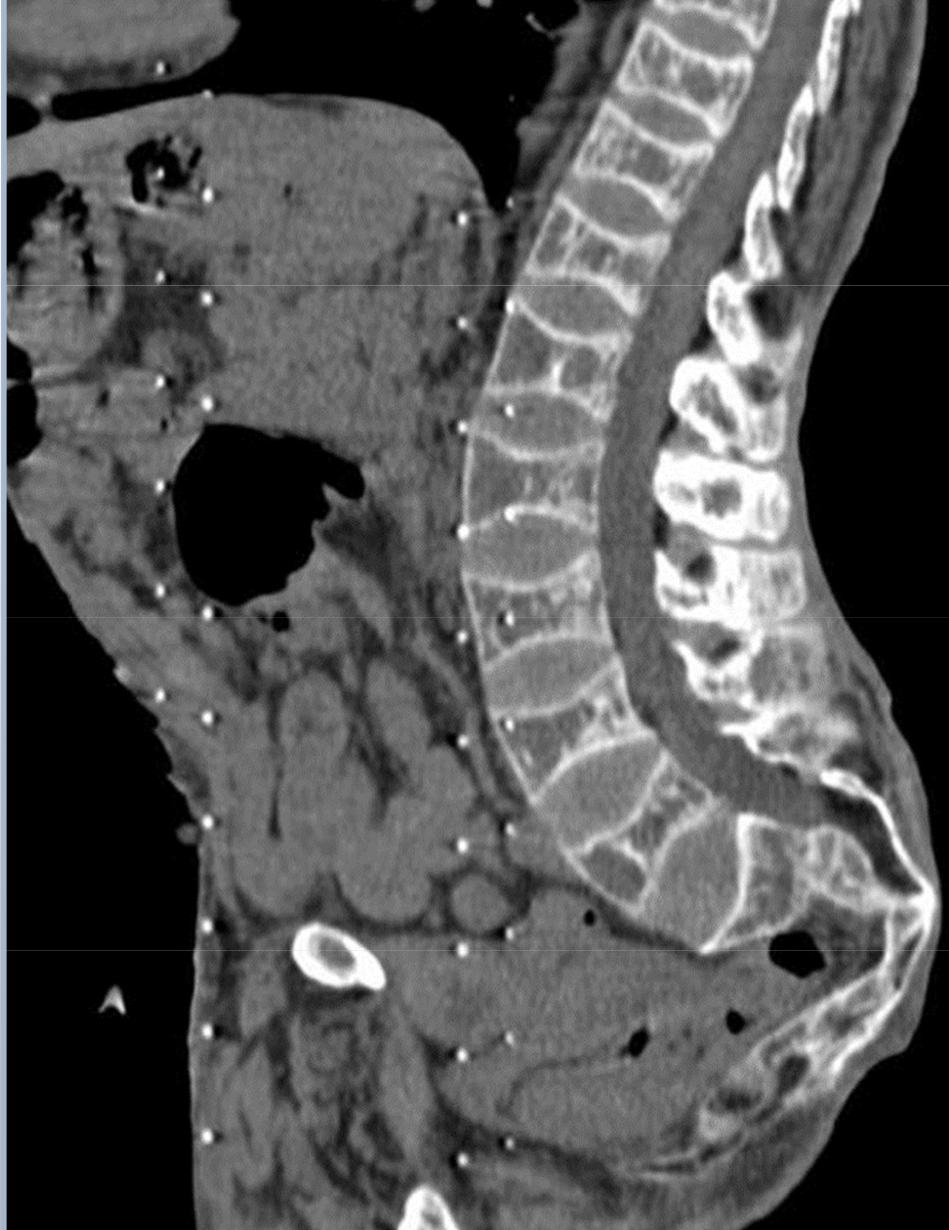 <p>This patient has hyperparathyroidism which has caused ______ and fractures that made the VB to be smaller than the IVDs</p>