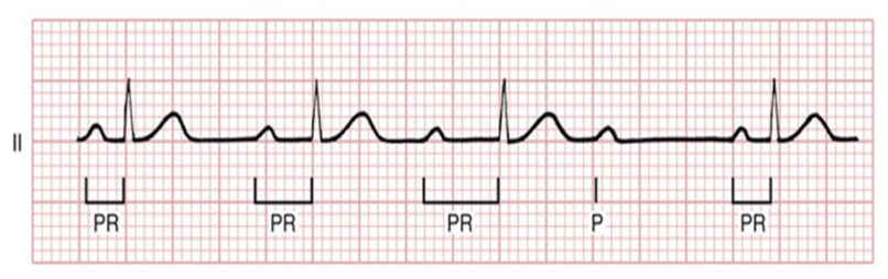 <p>howd you know this was a mobitz type 1 HB</p>