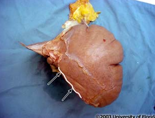 <p>what part of the coronary ligament of the liver is being highlighted?</p>