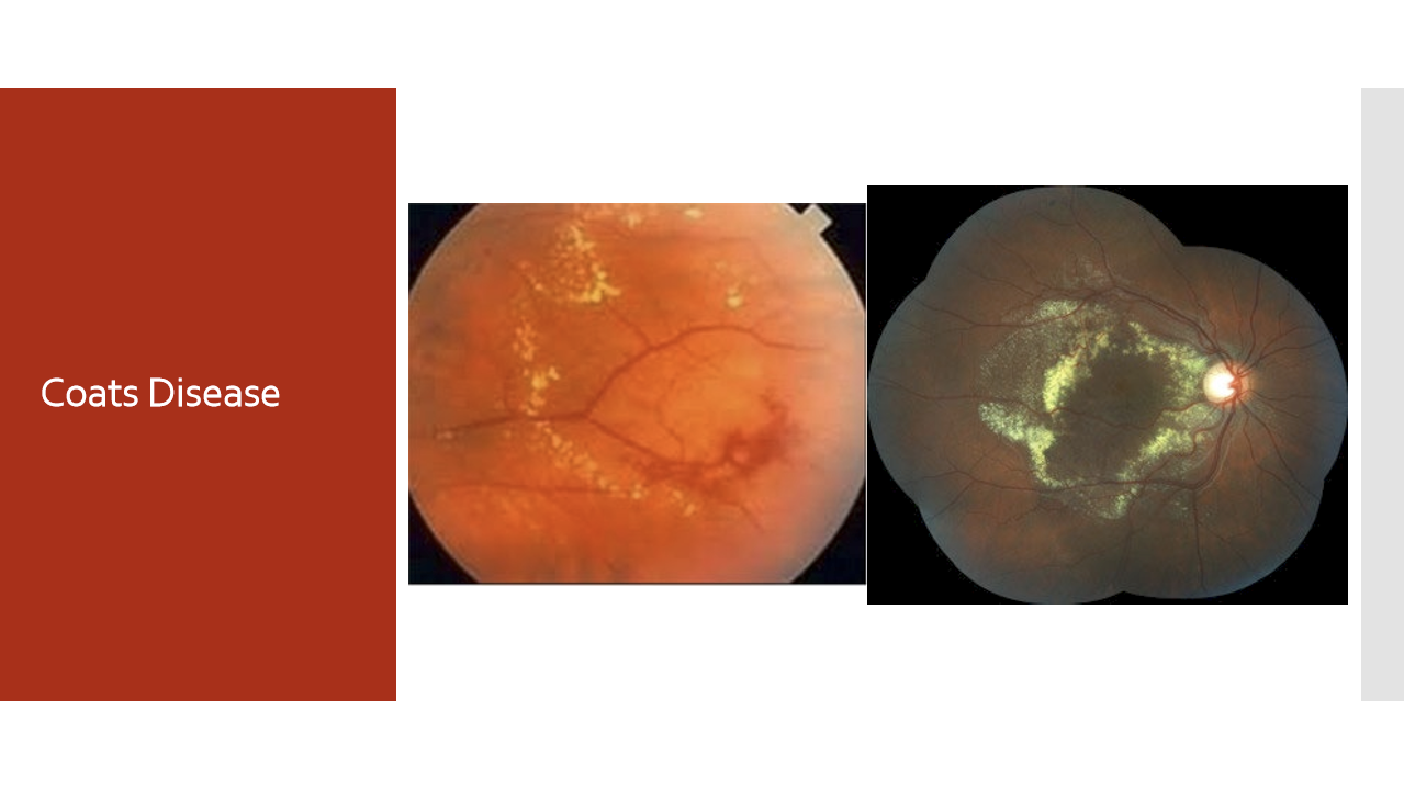 <p>Accumulation of retinal exudates and/or progression to exudative retinal detachment can produce a white pupillary reflex (leukocoria), making it an important differential diagnosis of retinoblastoma.</p><p></p>