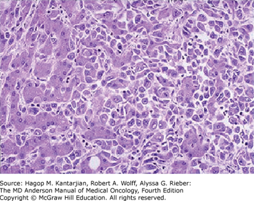 <p>irreg thickend cords of pleomorphic atypical cells with frequent prominent nuclei</p>