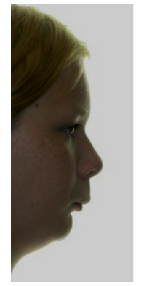 <p>Retrognathic</p>