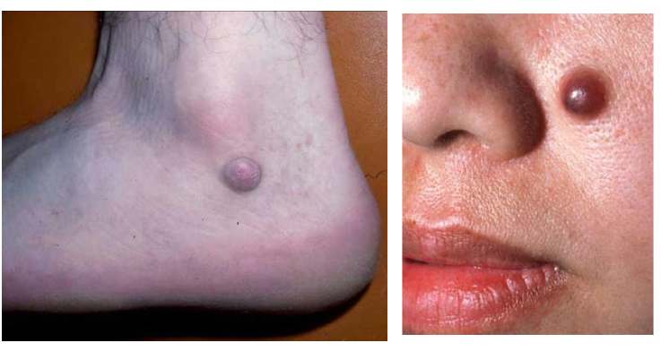 <p>Nodule</p><p>_____ cm in length AND depth</p>