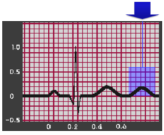 <p>▪ Nav bieži atradne normālā EKG</p><p>▪ konkordanti ar T viļņiem</p><p>▪ izteiktākie V2-V4</p><p>bērniem un sportistiem raksturīgs</p>