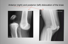 <p>Dislocation</p>