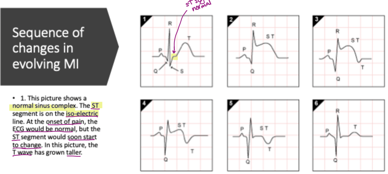<p><strong>Tall, peaked T waves</strong></p>
