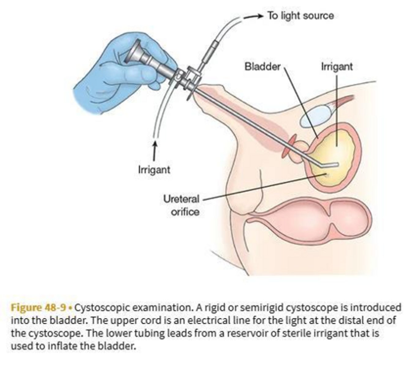 <p>Cystography detects bladder injury; VCUG uses x-rays during urination to detect ureteral reflux.</p>
