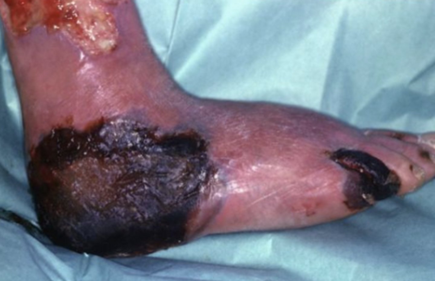 <p>decaying dead tissue</p>