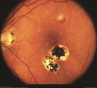<p><u>Fungus, abnormal blood vessel growth → blindness</u></p><ul><li><p>Organism: Histoplasmosis capsulatum</p></li><li><p>Transmission: Contaminated soil</p></li><li><p>Treatment: Goal is to stop further damage</p></li><li><p>Epidemiology: Central US: causes blindness</p></li></ul><p></p>