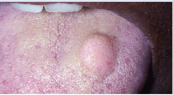<ul><li><p>a benign soft tissue neoplasm showing significant predilection for oral cavity</p></li><li><p>of schwann cells origin</p></li><li><p>tongue as the single most common site of involvement </p></li><li><p>treatment: conservative surgical excision </p></li></ul><p></p>