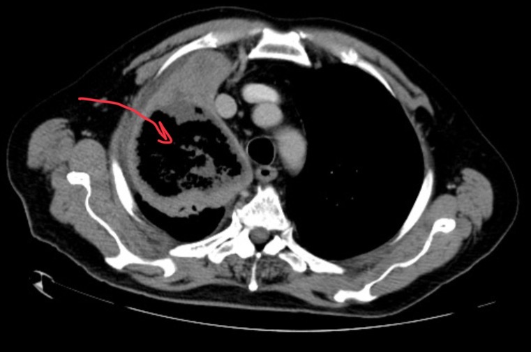 <p>60-year-old male has been treated for AML. Patient has cough, fever and dyspnea.</p>