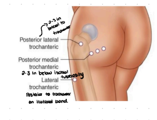 <p>posterior to trochanter on iliotibial (IT) band (go below booty cheeks and then go laterally all the way to where you’re on the leg)</p>
