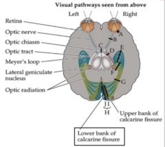 <p>inferior optic radiations</p>