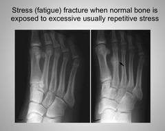 <p>Stress (fatigue) fracture</p>