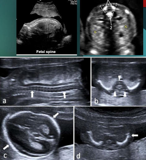 <ul><li><p><span style="background-color: transparent;">Rare and lethal group of genetic disorders that impair cartilage and bone development</span></p></li><li><p><span style="background-color: transparent;">Associated w/ IUGR, cleft soft palate, cystic hygroma, and hydrops fetalis</span></p></li><li><p><span style="background-color: transparent;">US findings:</span></p><ul><li><p><span style="background-color: transparent;">Hypomineralization (absent ossification of vertebral bodies)&nbsp;</span></p></li><li><p><span style="background-color: transparent;">Narrow thorax</span></p></li><li><p><span style="background-color: transparent;">Bone fractures</span></p></li><li><p><span style="background-color: transparent;">Micromelia</span></p></li><li><p><span style="background-color: transparent;">Micrognathia</span></p></li><li><p><span style="background-color: transparent;">Large head w/ slightly decreased ossification of the cranium</span></p></li></ul></li></ul><p></p>