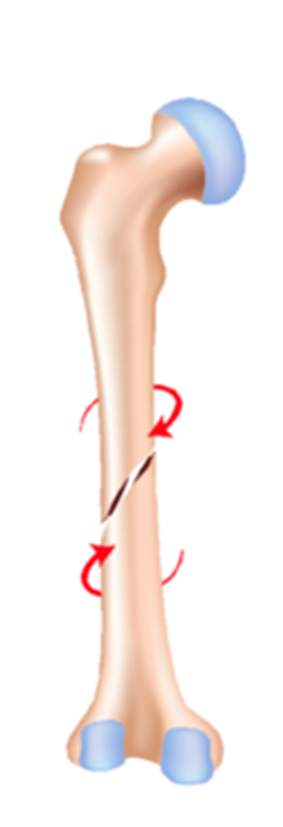 <p>a bone fracture that results from excessive twisting forces </p><p>common sports injury</p>