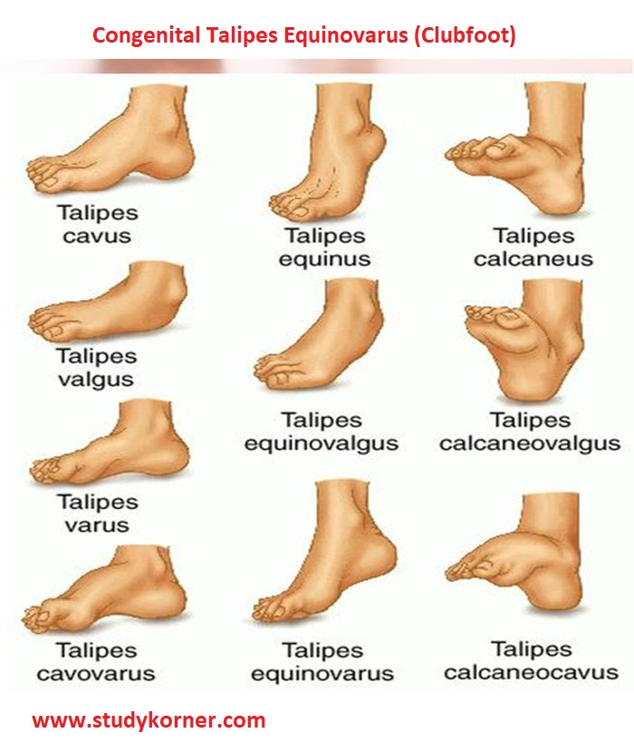 <p>Talipes= foot</p><p>equino= near toes </p><p>valgus= outward heel tilt</p><p>varus=inward tilt to the middle</p><p>calcane= back of foot  </p>